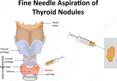 Fine Needle Aspiration of Thyroid Nodules
