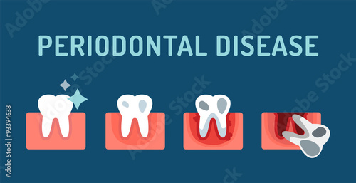 Periodontal disease stage steps vector illustration