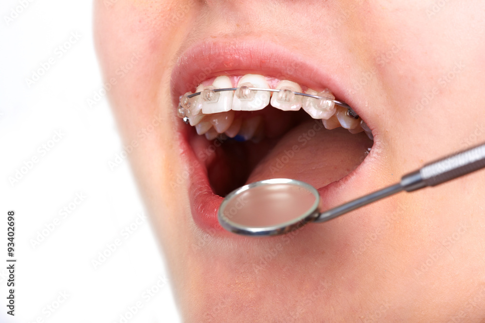 Naklejka premium Zęby z zamkami ortodontycznymi.