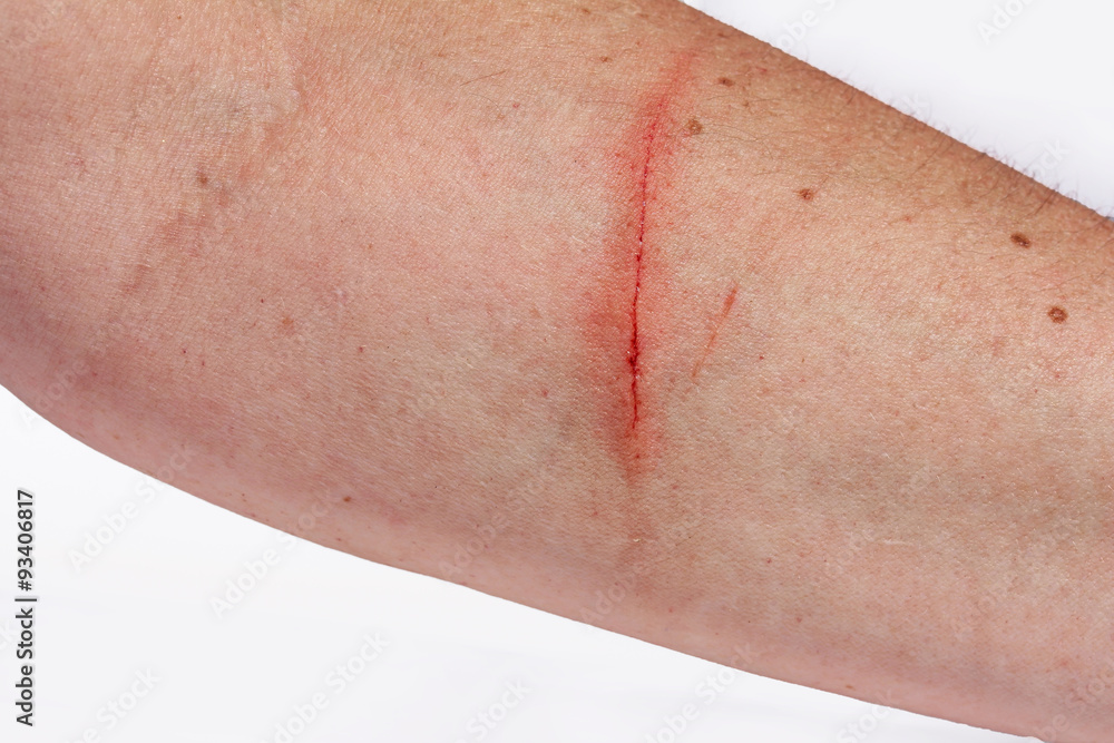 Ein blutiger entzündeter Kratzer am Arm einer Frau Photos