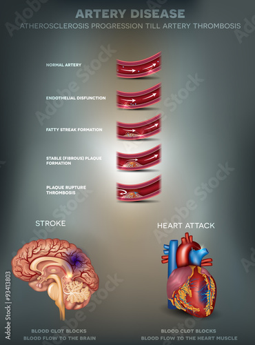 Artery disease, Atherosclerosis, Stroke and Heart attack