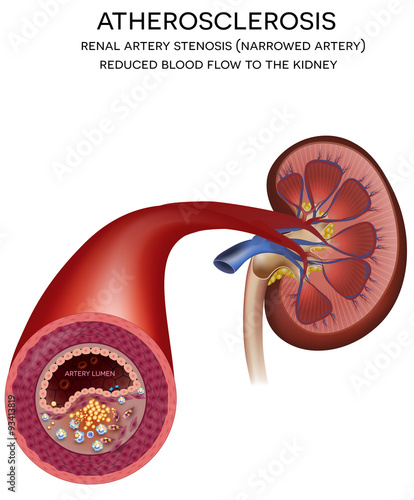 Renal artery disease. Atherosclerosis