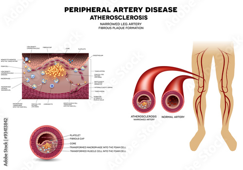 Leg artery disease, Atherosclerosis