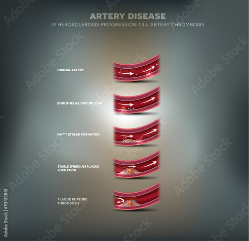 Artery disease, Atherosclerosis progression and blood clot