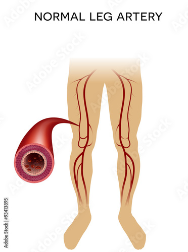 Healthy leg artery