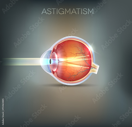 Astigmatism, vision disorder photo