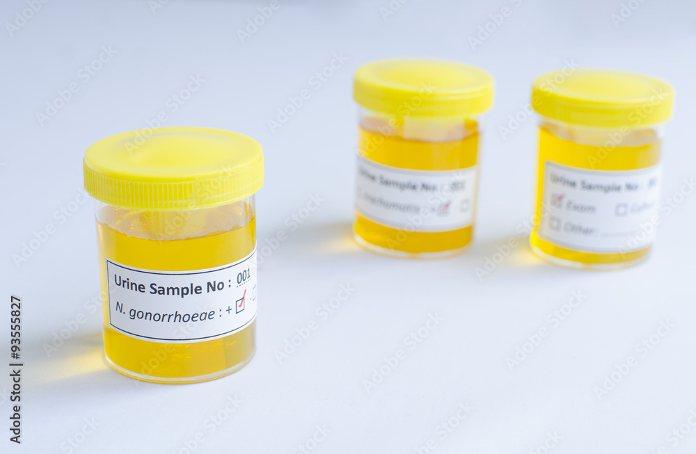 Gonorrhea Urine
