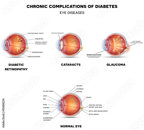 Fototapeta Naklejka Na Ścianę i Meble -  Diabetic Eye Diseases