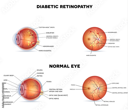 Diabetic retinopathy photo