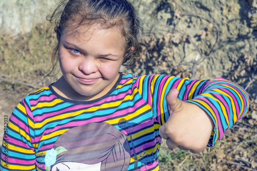 DownSyndrome Girl - Stock Image photo