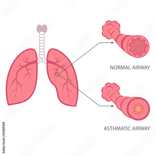 vector asthma illustration, bronchial, lungs respiratory disease,