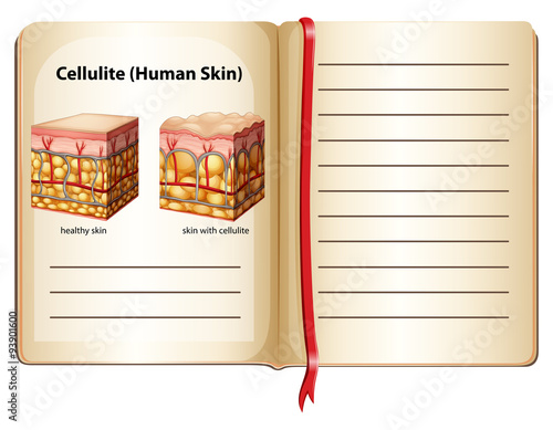 Cellulite under human skin