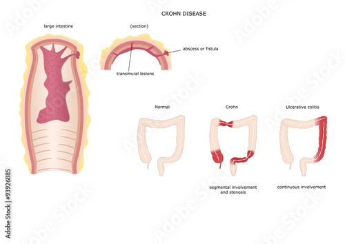 Morbo di Crohn, malattia autoimmune dell'intestino photo