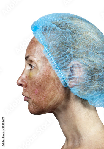 Cosmetology.Skin in the course of rejection after a deep chemical peeling.. photo