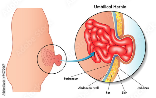 ernia ombelicale photo