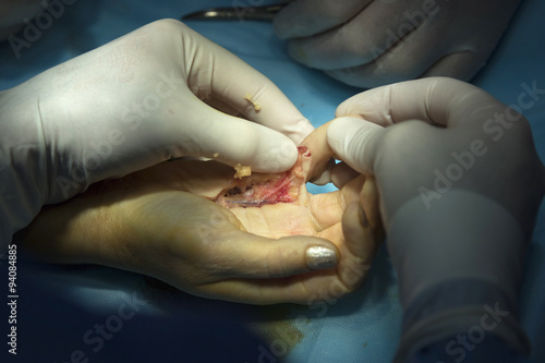 Hand Surgery with open wound