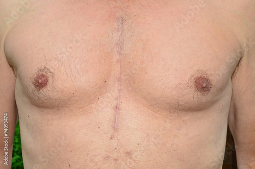 Male chest 6 months after open heart surgery