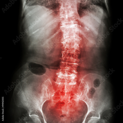 Canvas Print Spondylosis and Scoliosis ( film x-ray lumbar - sacrum spine show crooked spine