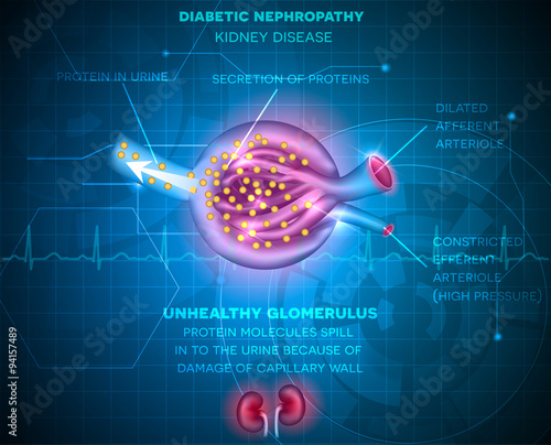 Diabetic Nephropathy, kidney disease photo