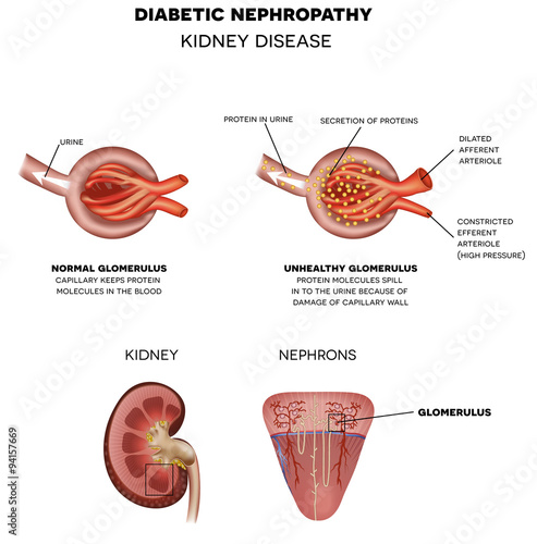 Diabetic Nephropathy, kidney disease