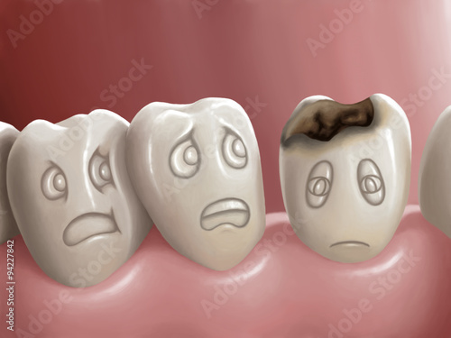 Dental caries photo