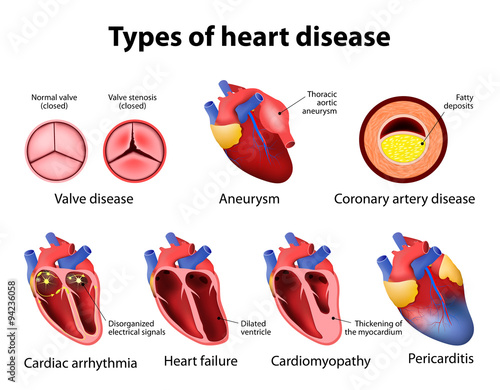 heart disease
