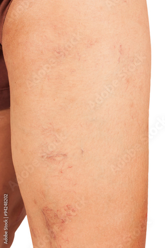 Varicose veins on the legs of middle-aged women.