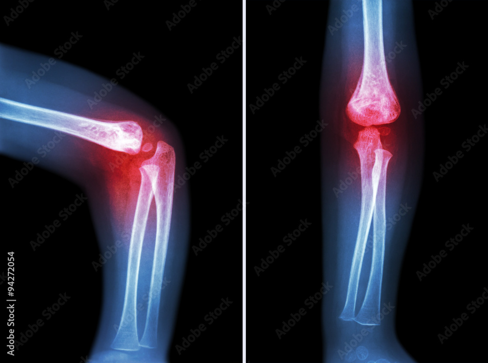 Rheumatoid Arthritis Gouty Arthritis Film X ray Child s Elbow With rheumatoid-arthritis-gouty-arthritis-film-x-ray-child-s-elbow-with