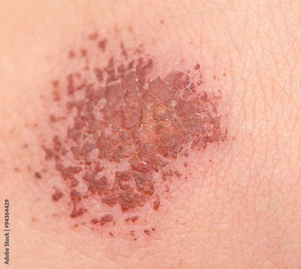 Fototapeta premium wound in human skin