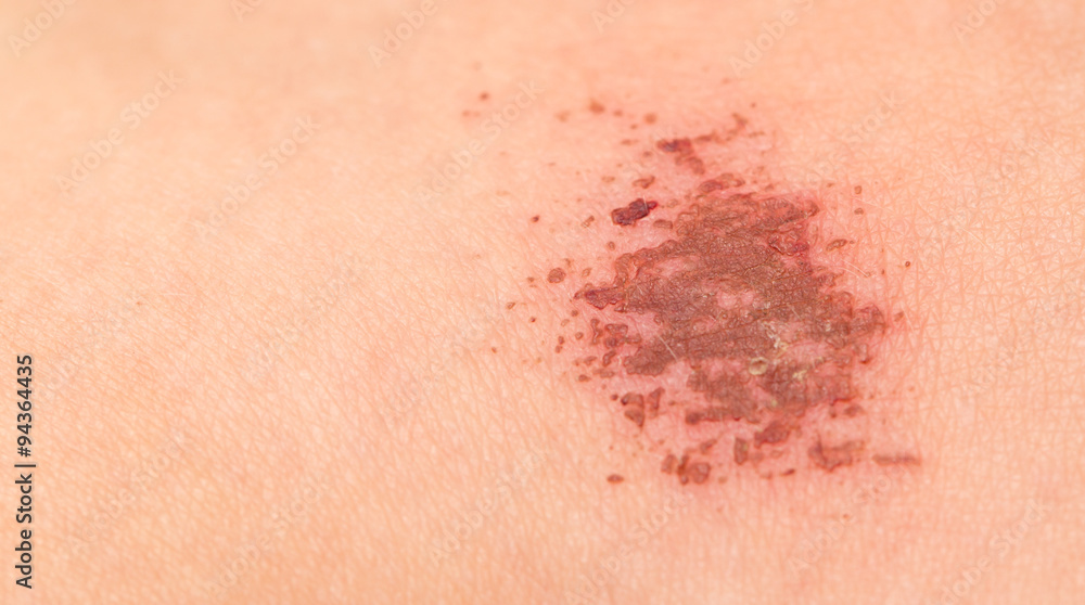 Fototapeta premium wound in human skin