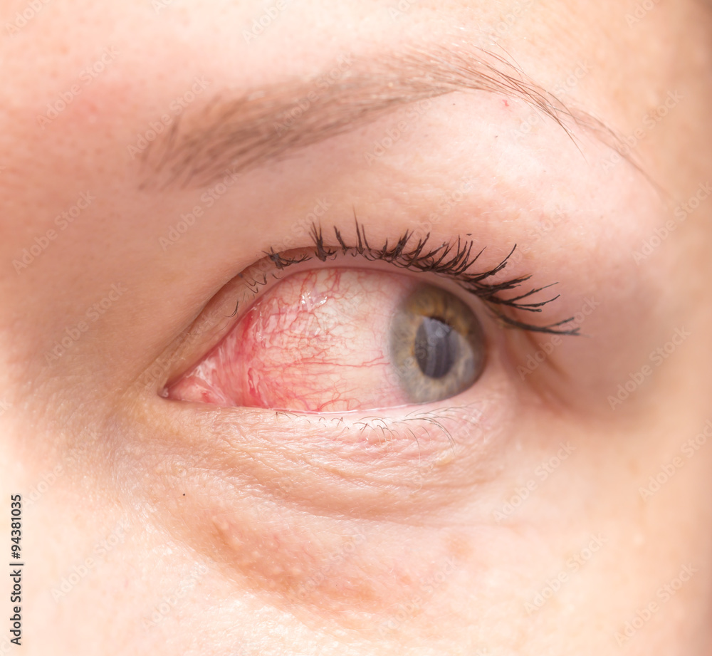 Obraz premium irritated eye