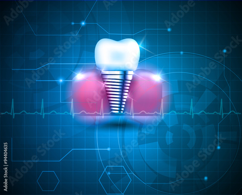 Dental implant
