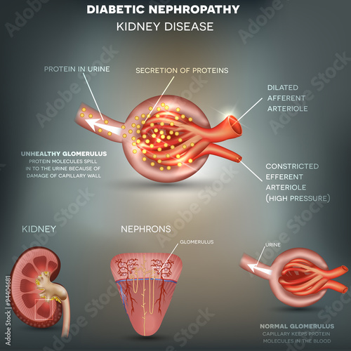 Diabetic Nephropathy, kidney disease