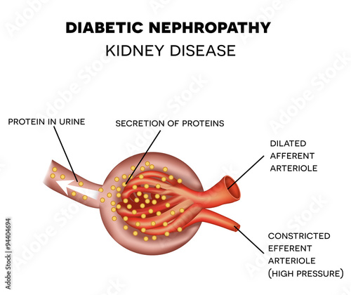 Diabetic Nephropathy, glomerulus anatomy photo