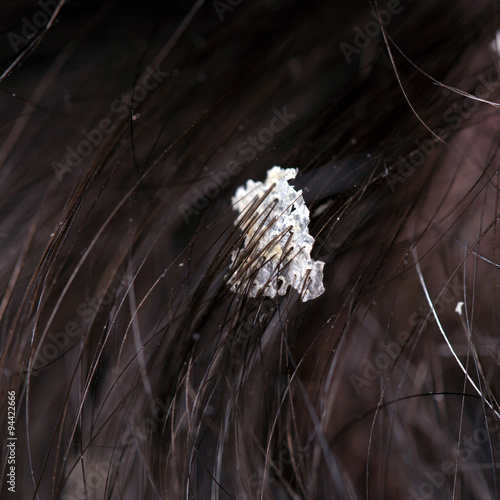Dandruff in the hair. Flaky scalp.