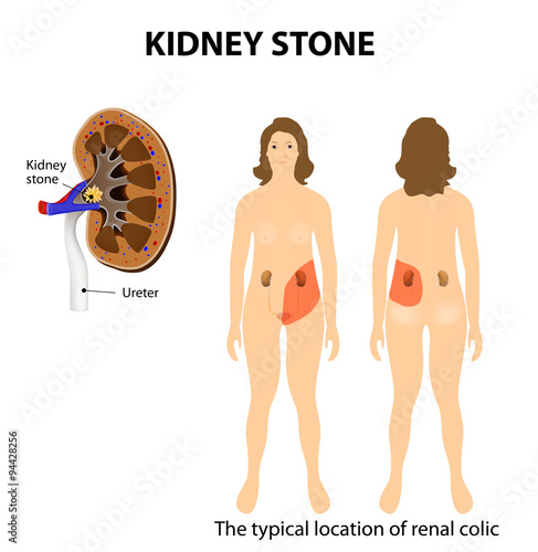 Kidney stone