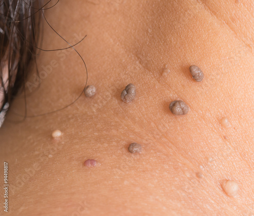 skin of a woman with moles