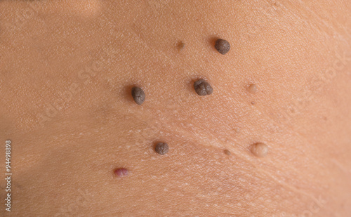 skin of a woman with moles
