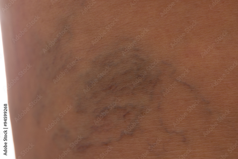 Fototapeta premium Varicose vein women Isolated on white background