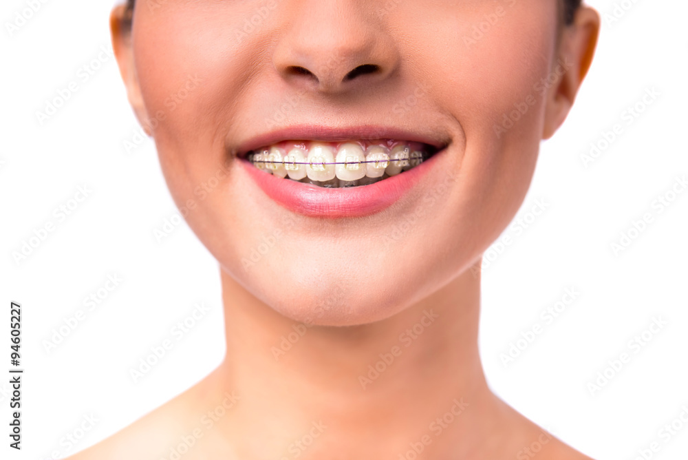 Obraz premium Woman with braces