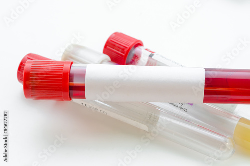 Blood sample test and empty tube blood for blood test screening