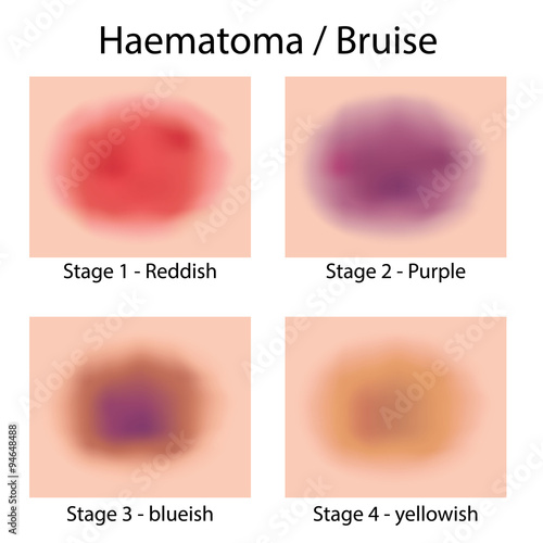 Illustration body with varying hematoma, bruise photo