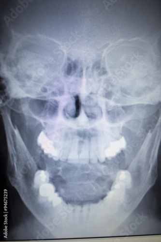 X-ray orthopedics Traumatology scan nose injury breathing