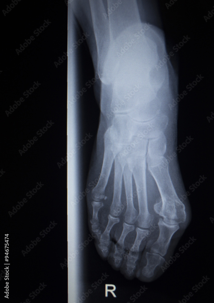 X-ray orthopedics scan of foot injury anterior posterior AP X-ray orthopedics scan of foot injury anterior posterior AP