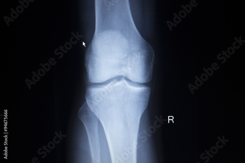 X-ray orthopedics scan of painful knee meniscus leg injury