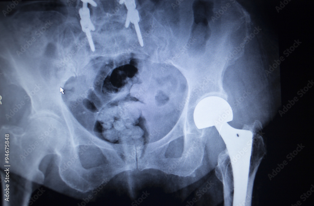 X-ray scan image of hip joint replacement orthopedic implant Stock ...