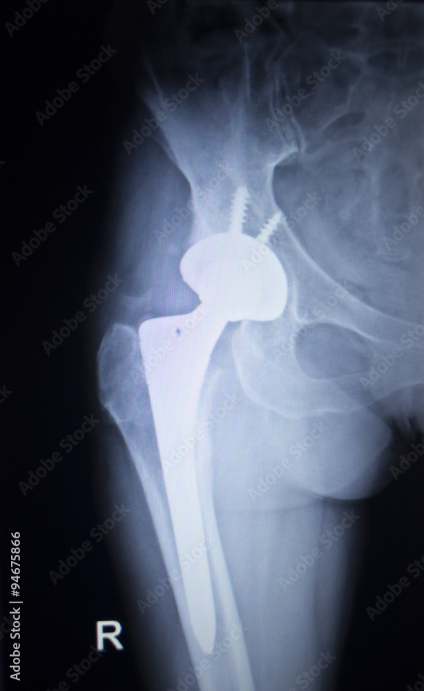 X-ray scan image of hip joint replacement orthopedic implant Stock ...