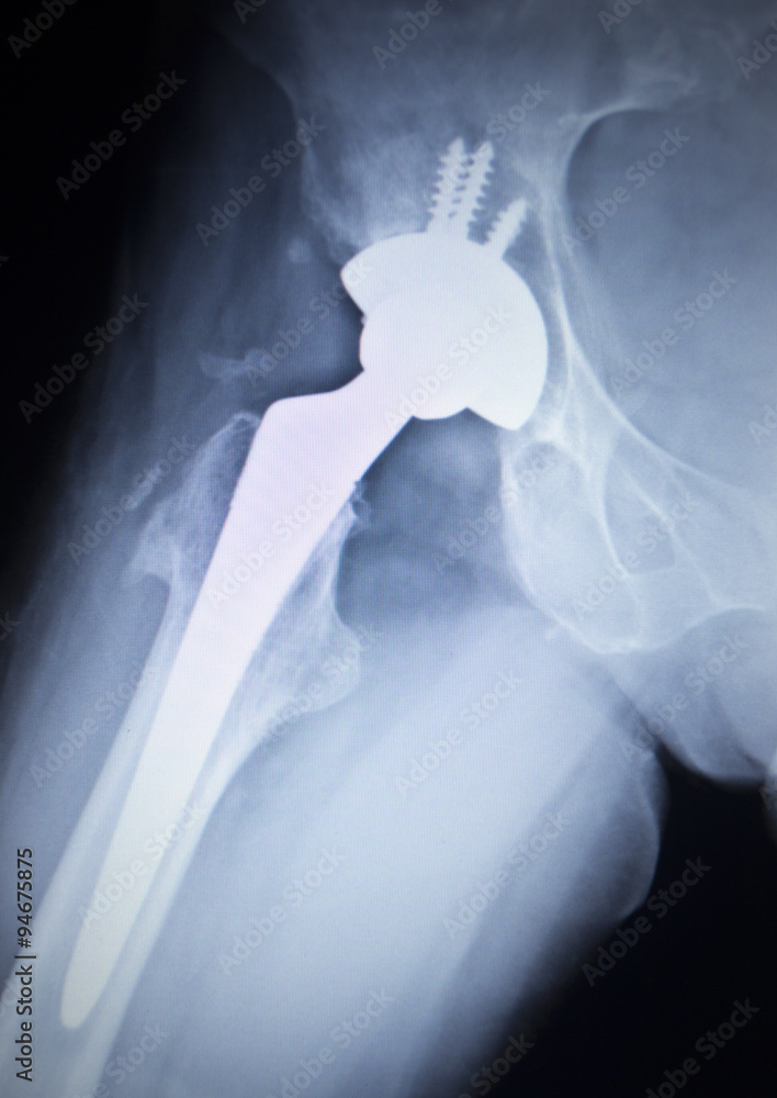 X-ray scan image of hip joint replacement orthopedic implant Stock ...