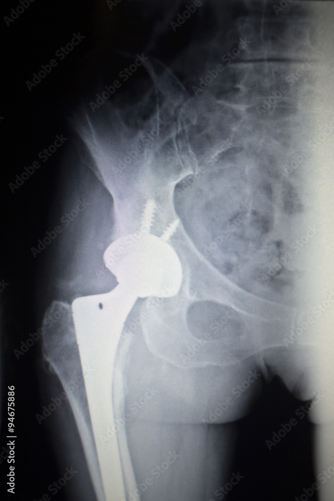 X-ray scan image of hip joint replacement orthopedic implant Stock ...