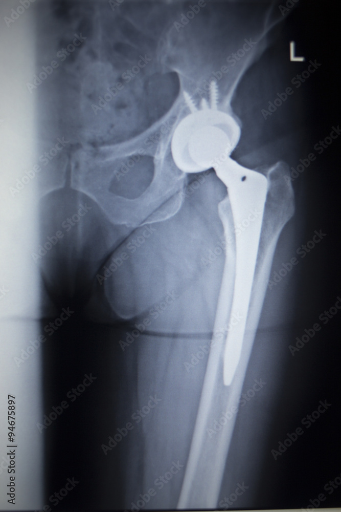 X-ray scan image of hip joint replacement orthopedic implant Stock ...